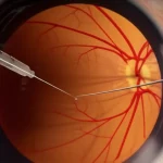 Visualizzazione artistica ma realistica dell'interno di un occhio umano che mostra la retina e il corpo vitreo durante un intervento chirurgico, con un focus sull'iniezione di un farmaco vicino al polo posteriore. Illuminazione chirurgica, alta definizione, obiettivo macro 85mm.