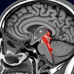 Illustrazione medica che mostra un cervello umano con una sezione trasversale che evidenzia il cervelletto e le aree circostanti potenzialmente colpite da metastasi, con un focus sulla compressione del quarto ventricolo. Stile fotorealistico, obiettivo macro 90mm, illuminazione da studio per dettagli nitidi, sfondo scuro per contrasto.