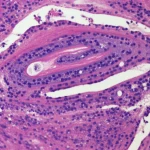 Immagine fotorealistica di un rene umano sezionato, obiettivo macro 100mm, con illuminazione da studio controllata per evidenziare in alta definizione le delicate strutture glomerulari e tubulointerstiziali. Alcune aree mostrano segni di infiammazione e fibrosi, tipici della nefropatia diabetica, con macrofagi visibili come piccole cellule infiltranti. L'immagine ha una profondità di campo ridotta per focalizzare l'attenzione su un glomerulo specifico.