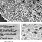 Macro lens, 100mm, high detail, controlled lighting, raffigurante un gruppo di cellule di leucemia mieloide acuta (LMA) con alcune che mostrano segni di apoptosi (morte cellulare programmata) a causa dell'azione combinata di (R)-WAC-224, venetoclax e azacitidina, a simboleggiare una svolta nel superamento della farmaco-resistenza.