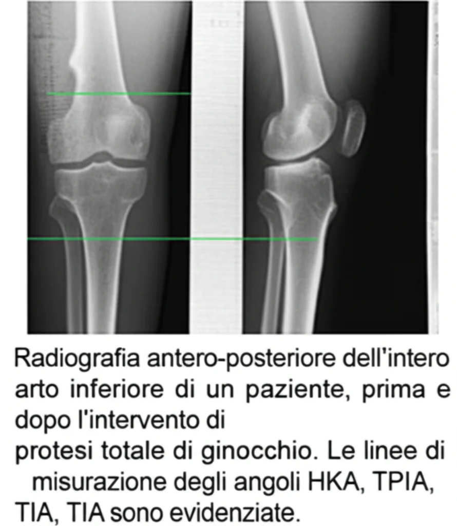 Radiografia antero-posteriore dell'intero arto inferiore di un paziente, prima e dopo l'intervento di protesi totale di ginocchio. Le linee di misurazione degli angoli HKA, TPIA, TIA sono evidenziate. Immagine medica ad alta definizione, con focus sui dettagli ossei, come se fosse visualizzata su un negatoscopio luminoso. Utilizzare un obiettivo da 50mm per una prospettiva naturale, con illuminazione controllata per massimizzare il contrasto e la leggibilità delle strutture anatomiche e delle linee di misurazione.