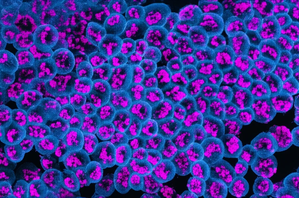 Immagine macro ad alta definizione di cellule microgliali attivate nel tessuto cerebrale, che mostrano morfologie infiammatorie con ramificazioni ritratte e corpo cellulare ingrossato, con illuminazione controllata per evidenziare i dettagli cellulari. Lunghezza focale 100mm, stile fotorealistico, con un leggero duotone blu e magenta per enfatizzare lo stato patologico.