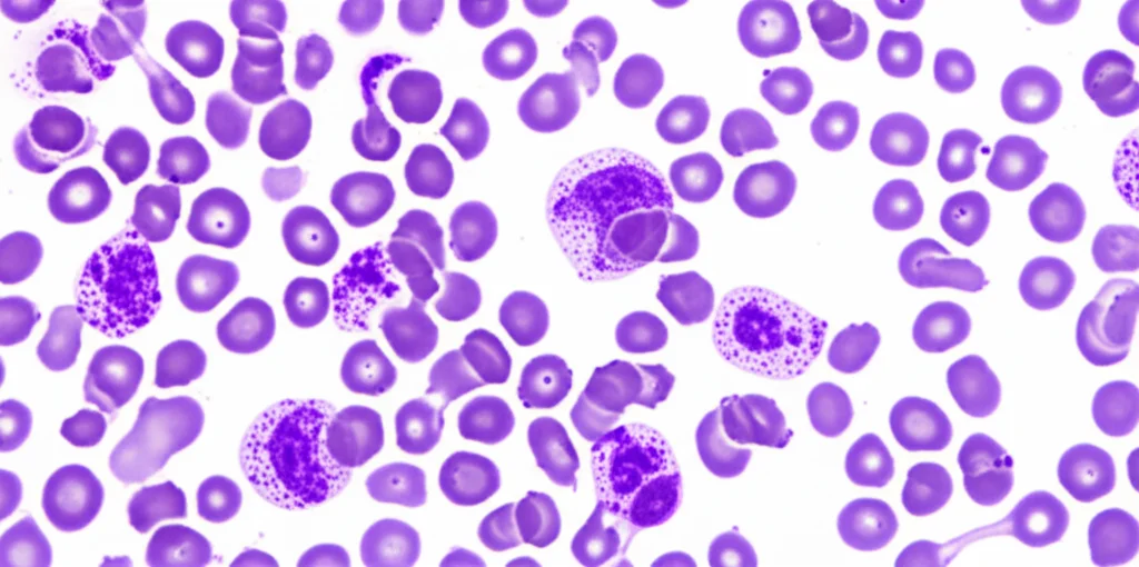 Primo piano di cellule del midollo osseo al microscopio, con evidenziazione di cellule eritroidi displastiche e blasti. Illuminazione controllata per dettagli morfologici, obiettivo macro 100mm, stile documentaristico scientifico.