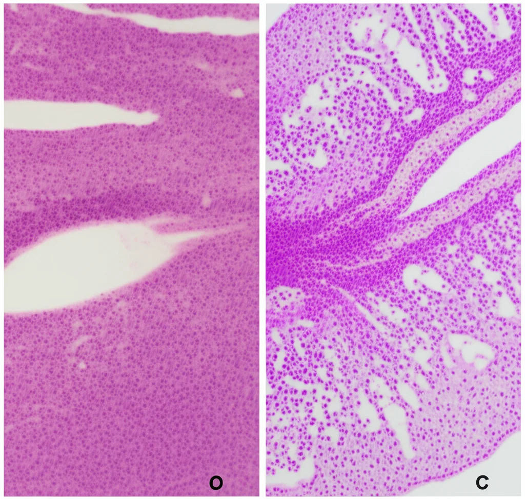Immagine macro di due campioni di tessuto tumorale esofageo su vetrini da microscopio, affiancati. Un campione (sinistra) mostra una risposta patologica completa (pCR) con assenza di cellule tumorali visibili, evidenziando tessuto sano o fibrotico post-trattamento. L'altro campione (destra) mostra una risposta non-pCR con cellule tumorali residue evidenti. Dettagli: Macro lens, 90mm, alta definizione, illuminazione da microscopio precisa per evidenziare le differenze cellulari, contrasto tra i due campioni.