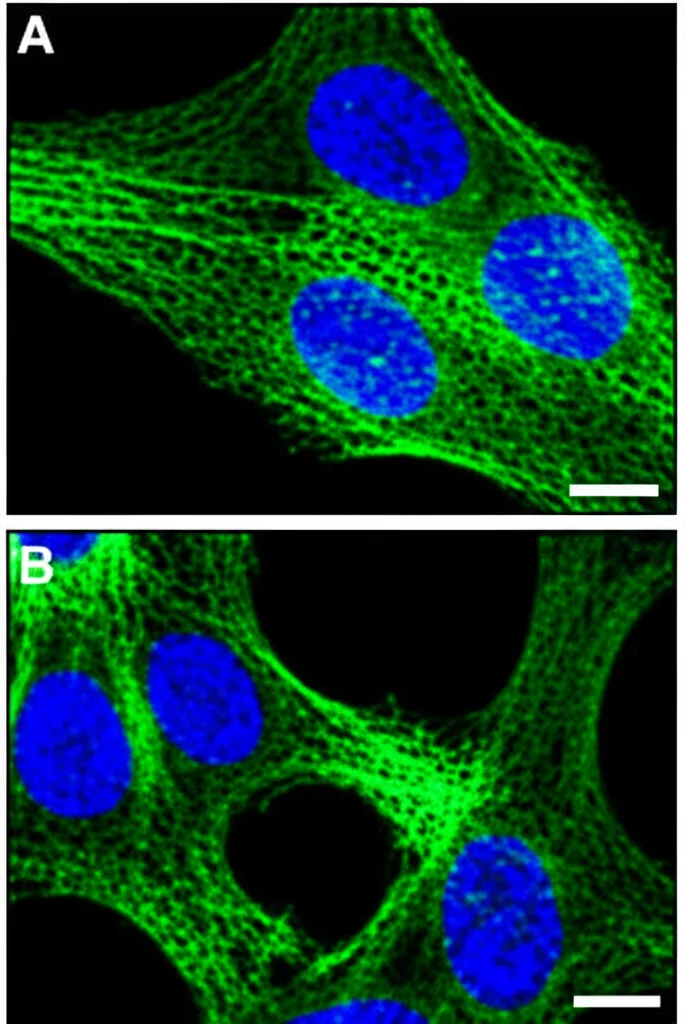 Immagine al microscopio confocale di cellule tumorali polmonari che mostrano marcatori di ferroptosi. Alcune cellule emettono fluorescenza verde (indicativa di perossidazione lipidica) e rossa (nuclei). L'immagine deve essere ad alta risoluzione, con un obiettivo macro da 60mm per dettagli precisi, e illuminazione specifica per fluorescenza, creando un contrasto netto tra i segnali.