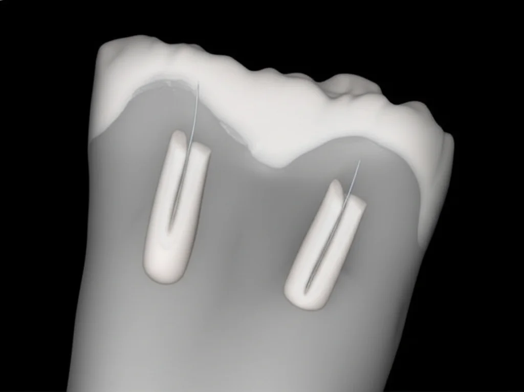 Immagine 3D rendering da CBCT di un primo molare mandibolare che mostra chiaramente la configurazione del canale radicolare a forma di C, con focus sulla fusione radicolare e la presenza di quattro canali separati nel terzo medio. Illuminazione digitale per massima chiarezza.