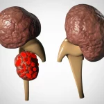 Visualizzazione 3D medica ultra-realistica che mostra una ghiandola surrenale ingrossata con un tumore (carcinoma surrenalico pediatrico) accanto a un rene controlaterale sano e un rene con piccoli calcoli di acido urico rosso mattone visibili nel sistema collettore, illuminazione clinica precisa focalizzata sulle aree patologiche, alta definizione, sfondo neutro.