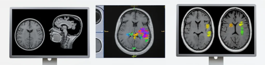 Due schermi medici affiancati, uno mostra una scansione MRI cerebrale in scala di grigi ad alta definizione, l'altro una scansione PET colorata che evidenzia l'attività metabolica. Al centro, un'immagine fusa che combina la chiarezza strutturale dell'MRI con i dati funzionali del PET. Obiettivo prime 35mm, illuminazione da studio, alta definizione, fotorealistico.