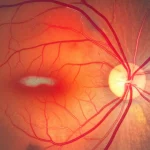 A high-detail macro image of an optical coherence tomography (OCT) scan of the human retina, showing distinct layers and a subtle anomaly highlighted by a heatmap overlay. The image uses precise focusing and controlled lighting to emphasize the fine structures, captured with a 105mm macro lens, suitable for medical imaging context.