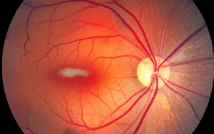 A high-detail macro image of an optical coherence tomography (OCT) scan of the human retina, showing distinct layers and a subtle anomaly highlighted by a heatmap overlay. The image uses precise focusing and controlled lighting to emphasize the fine structures, captured with a 105mm macro lens, suitable for medical imaging context.