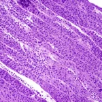 Immagine fotorealistica al microscopio di un neoplasma solido pseudopapillare del pancreas (SPN), obiettivo macro 100mm, alta definizione, con cellule tumorali uniformi che formano strutture solide e pseudopapillari. In evidenza la colorazione immunoistochimica nucleare per β-catenina, segno distintivo di questo tumore. Illuminazione controllata e messa a fuoco precisa sui dettagli cellulari.