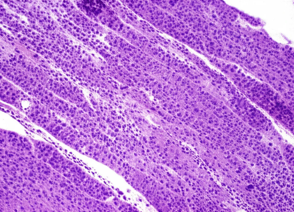 Immagine fotorealistica al microscopio di un neoplasma solido pseudopapillare del pancreas (SPN), obiettivo macro 100mm, alta definizione, con cellule tumorali uniformi che formano strutture solide e pseudopapillari. In evidenza la colorazione immunoistochimica nucleare per β-catenina, segno distintivo di questo tumore. Illuminazione controllata e messa a fuoco precisa sui dettagli cellulari.