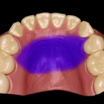 Visualizzazione 3D fotorealistica di un modello dentale mascellare su schermo di computer, con l'Area B del palato evidenziata in colore viola per la sovrapposizione. Tecnologia medica avanzata in ambito ortodontico, obiettivo macro 85mm, illuminazione da studio focalizzata sul modello, alta definizione dei dettagli delle rughe palatine e della superficie dentale.