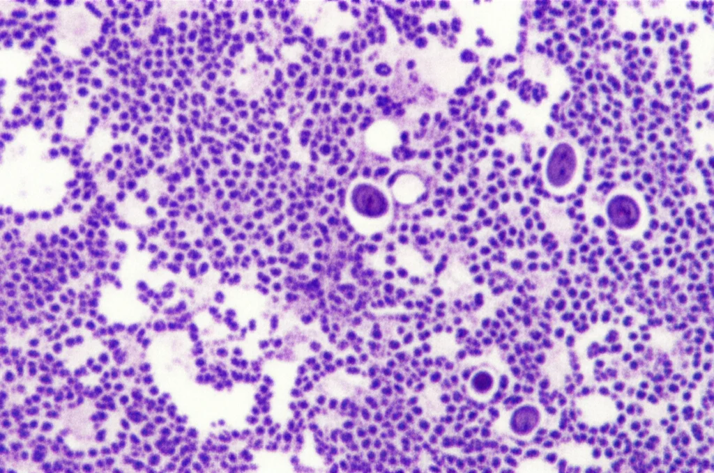 Immagine macro ad alta definizione di cellule di melanoma anorettale visualizzate al microscopio, illuminazione controllata, obiettivo macro 100mm, focus preciso sui dettagli cellulari atipici e sulla pigmentazione melaninica sparsa.