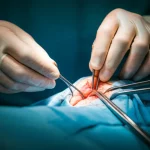 Close-up photorealistic image of a surgeon's hands carefully dissecting tissue near a bone during orthopedic surgery, prime lens, 35mm, depth of field focusing on the hands and surgical field.