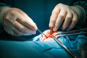 Close-up photorealistic image of a surgeon's hands carefully dissecting tissue near a bone during orthopedic surgery, prime lens, 35mm, depth of field focusing on the hands and surgical field.