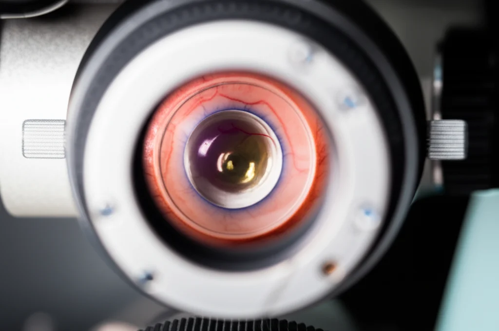 Photorealistic image of a slit-lamp microscope examining an eye with an IOL, macro lens, 60mm, high detail, precise focusing, controlled lighting.