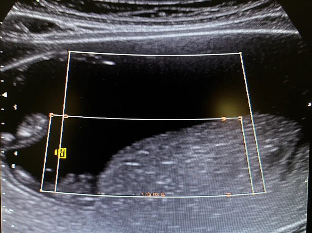 Close-up view of an ultrasound screen showing a cross-section of the quadriceps muscle with measurement lines, macro lens, 60mm, high detail